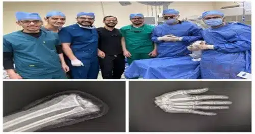 يد تعود إلى الحياة.. جراحة مصرية تذهل العالم