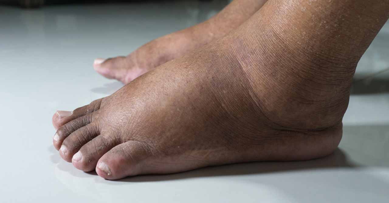 داء الفيل في مرمى العلاج.. حملة تبدأ من كسلا