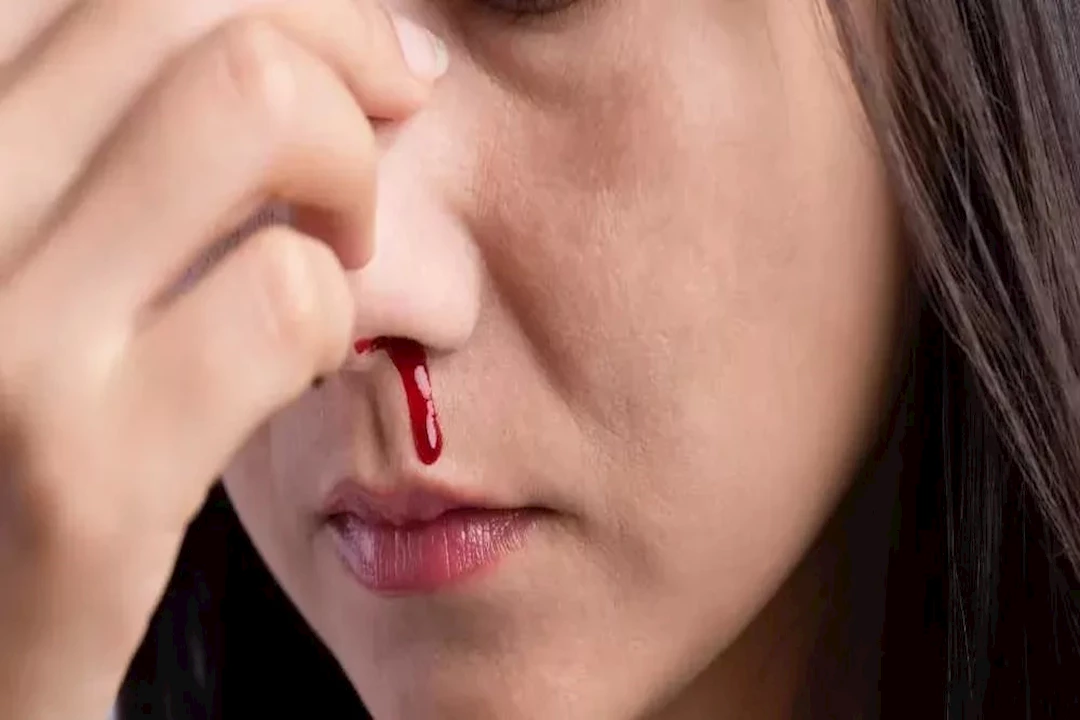 نزيف الأنف الجاف.. علاجات منزلية تريحك بسرعة