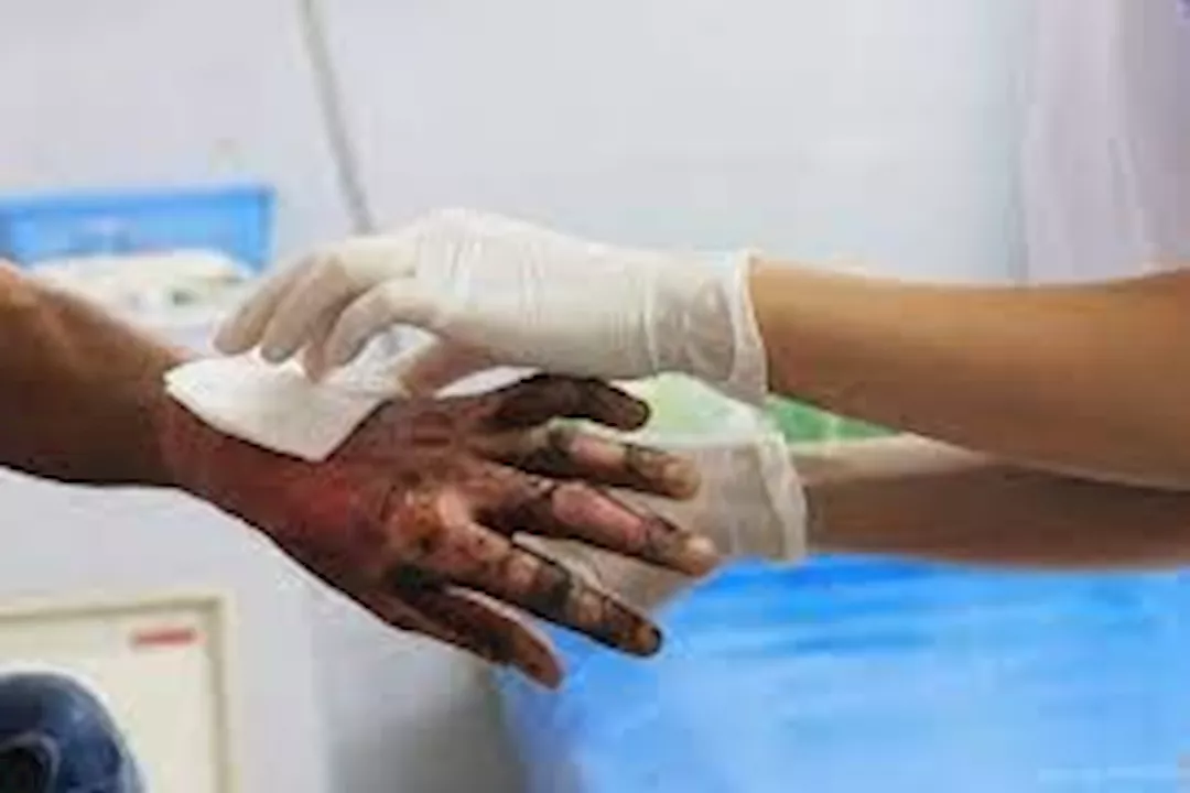 في اليوم العالمي لطب الطواريء.. طبيب يوضح إسعافات أولية لإصابات الحروق