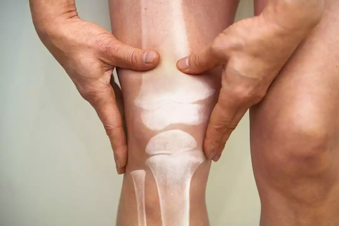 تخلص من التهاب مفاصل الركبة بهذه السهولة