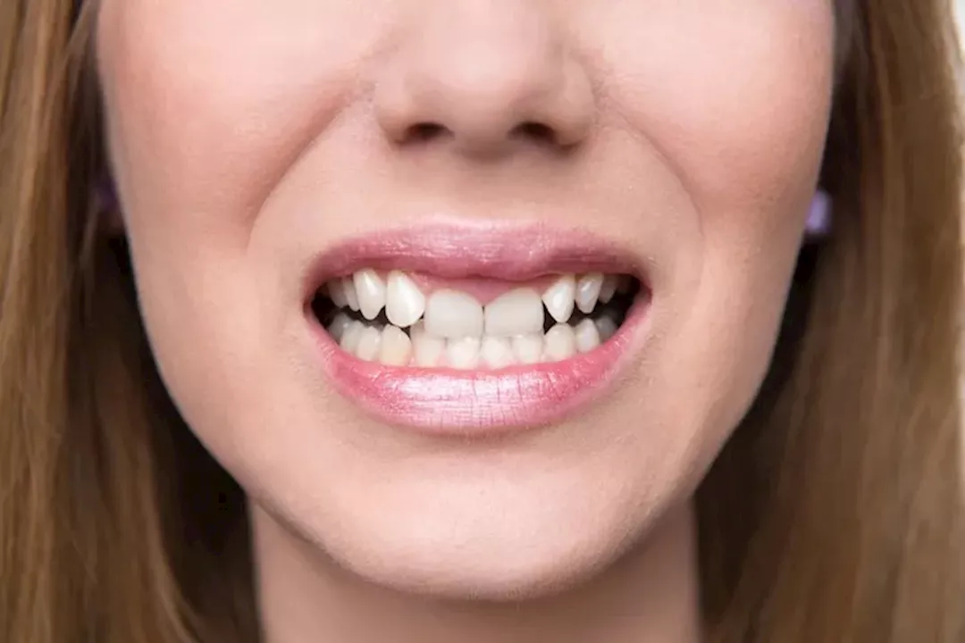 8 أسباب لانحناء الأسنان.. إليك كيفية تقويمها