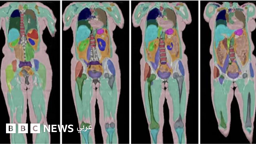 أضخم دراسة تصوير طبي للبشر تصل إلى مشاركها رقم 100 ألف