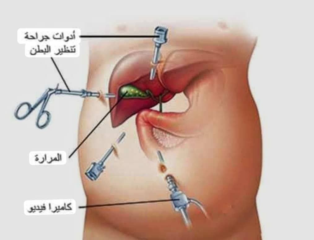 مستشفى أمدرمان يجري أول استكشاف للقناة المرارية بعد الحرب
