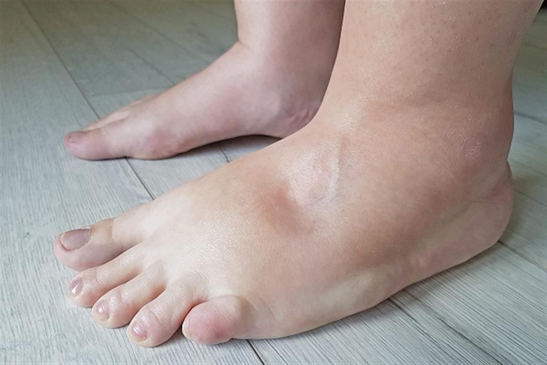 احرص على تناول هذه الأطعمة – تحميك من تورم القدمين