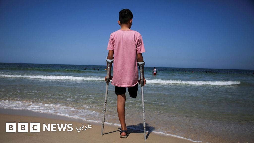 مبتورو الأطراف في غزة: محرومون من العلاج والتأهيل والسفر